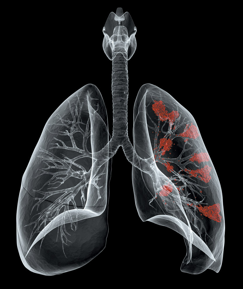 lung_cancer